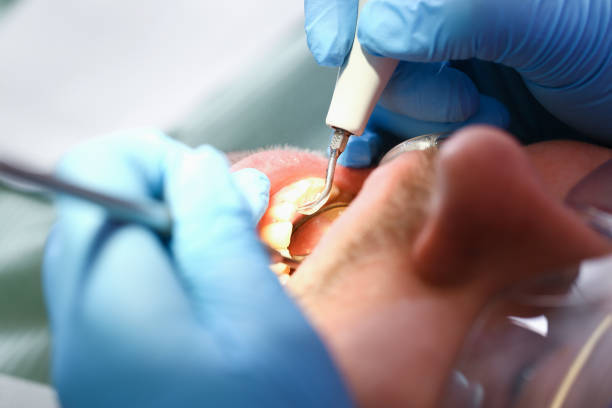 Best Emergency Dentist for Lost Fillings or Crowns in Haskins, OH